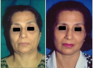 Face Lift Surgery in Chennai