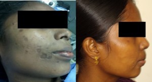 Surgery for Moles and Scars